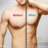 Gynecomastia in Milton