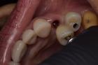 Full Mouth Dental Implants in Mexico with Teeth Savers