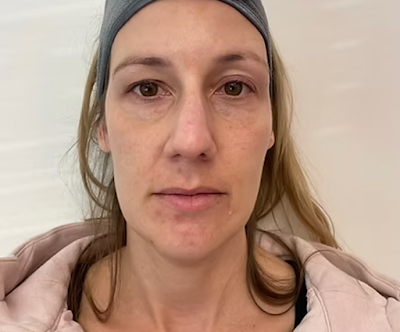 Sculptra Treatment Colorado Springs