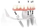 Denture on implants Los Angeles
