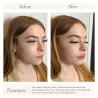 Face Filler vs Body Filler: Understanding the Difference and Choosing the Right One for You!